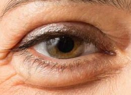 نحوه برداشتن پف چشم با روش‌های سنتی و مدرن
