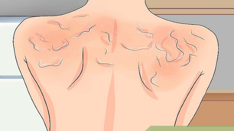 علائم افتاب‌سوختگی