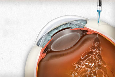 تزریق داخل چشمی